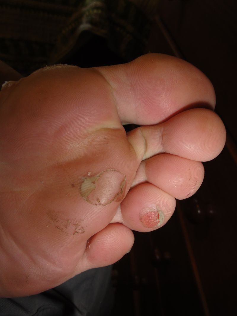 Bolhas causadas pelo atrito nos pés